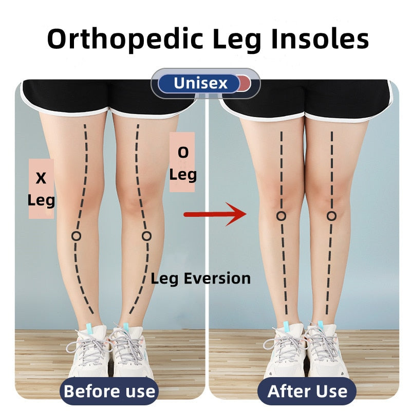 نعال تقويم العظام من السيليكون للأقدام O/X نوع الساق أروح التقوس تصحيح التهاب اللفافة الأخمصية نعل هلامي تدليك مغناطيسي للعناية بالقدم